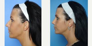 Benjamin C. Marcus, MD, Board Certified Facial Plastic Surgeon