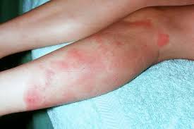 Image result for erythema nodosum