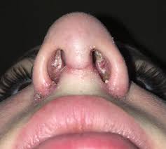 We did not find results for: Is It An Infection White Spots In My Nose 1 5 Weeks After Rhinoplasty Photos