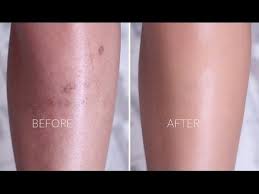 Makeup, instamakeup, cosmetic, cosmetics, envywear, fashion,veyeshadow, lipstick gloss, mascara, palettes, eyeliner, lip, lips, concealer, foundation, powder, eyes eyebrows, lashes, lash, glue glitter, crease, primers, base, beauty, beautiful previous. How I Cover Scarring Pigmentation Dark Spots On Legs Leg Makeup Cover Scar
