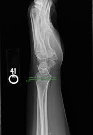Image result for Wrist XRay