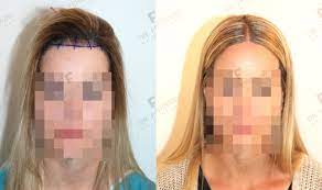 Internationaler kongress fue europe berlin 7. Haartransplantation Frauen So Funktioniert S Hairforlife