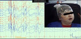 Check spelling or type a new query. Isolated Nostril Myoclonus A Novel Ictal Presentation In Structural Generalised Epilepsy Sciencedirect