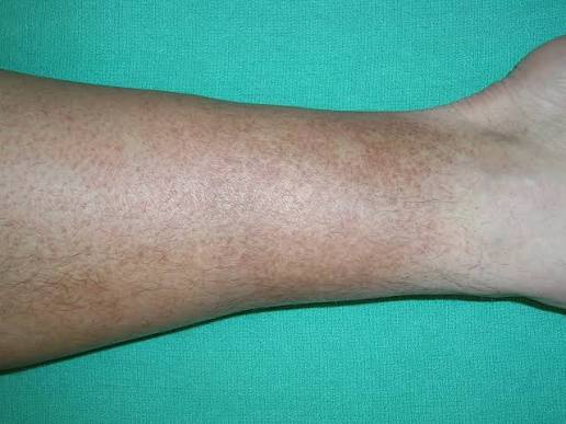 Leg Discoloration Specialist Near Me in Maryland, New Jersey, & Virginia