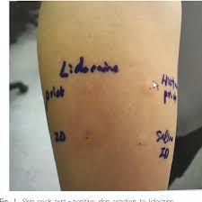 Image result for Local Skin Anesthesia