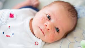 Bebeklerde Sivilce Neden Olur Tehlikeli Midir Anneysen