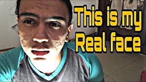 Improvment muka gue setelah subcision dan cutter