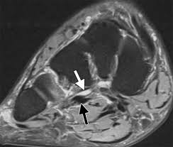 Abductor hallucis, flexor digitorium brevis, abductor digiti minimi 2nd layer: Plantar Tendons Of The Foot Mr Imaging And Us Radiographics