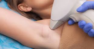 Everything You Need To Know About Laser Hair Removal Shape