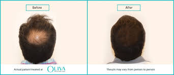 Prp (platelet rich plasma) treatment comes as a ray of hope and plays a vital role against hair loss. Prp Treatment For Hair Loss Cost And Success Rate In India 2020