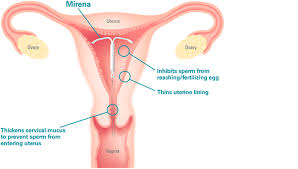 Get your birth control today and have it delivered to your home. Iud S Mirena Kyleena Skyla Paragard Wellesley Ma Near Boston Ma