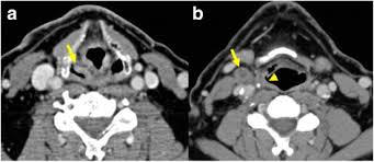A typical contrast ct works by injecting contrast into a vein (it can also be administered orally to highlight the bowel or through the rectum). Cross Sectional Imaging In Cancers Of The Head And Neck How We Review And Report Cancer Imaging Full Text