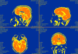 Mayo Clinic Brain Support Network