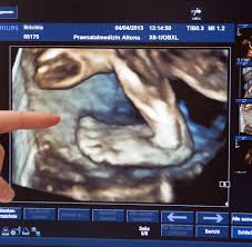 5% aller babys zu dem vom zeugungsrechner errechneten zeugungsdatum gezeugt wurden. Ultraschall Baby Fehlbildungen Mit Sonografie Fruher Erkennen Welt