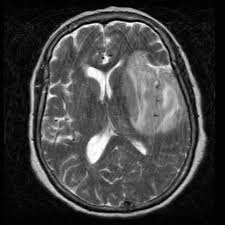 Encephalitis refers to an acute, usually diffuse, inflammatory process affecting the brain. Herpes Simplex Encephalitis Radiology Reference Article Radiopaedia Org