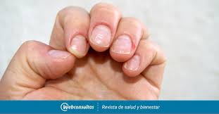 Unas Covid Que Indican Cambios En Las Unas Por Coronavirus