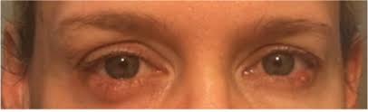 However, there are a handful of negative reviews from users who experienced side. Women Are Suing Rodan Fields Over Side Effects From One Of Its Most Popular Products