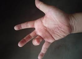 Jari telunjuk (fore finger) 8. Waspada Jari Tangan Kaku Dan Sakit Bisa Jadi Trigger Finger