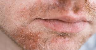 Image result for Seborrheic Dermatitis
