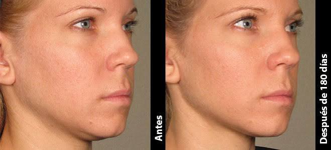 Antes & Después | Lifting para Cejas, Cuello, Escote & Mentón | Ultherapy