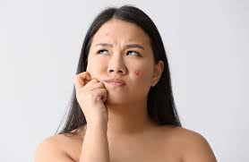 On november 5, 2019, the fda published this updated safety communication because the fda remains concerned about certain laboratory tests that have not addressed the risk of biotin interference. Does Biotin Cause Acne Learn The Facts Backed By Science