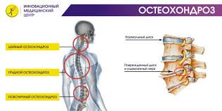 Lechenie Osteohondroza V Moskve Osteohondroz Pozvonochnika Prichiny Simptomy I Lechenie Bez Tabletok U Vzroslyh Innovacionnyj Reabilitacionnyj Centr