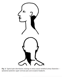 When some people complain about a pain in the neck, they really mean it.neck arthritis is very common presentation for primary care physicians and for. Can The Risk Of Vertebral Artery Dissection Be Determined With Pre Manipulative Screening Rayner Smale