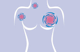 Experts from md anderson cancer center in houston warn that breast cancer often shows up without the classic breast cancer warning signs of lumps or redness. Where Does Breast Cancer Spread Cleveland Clinic