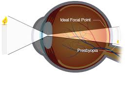 Image result for Presbyopia