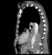 The amount of mesothelioma and cancer victims is increasing day by day across the globe. Malignant Pleural Mesothelioma Presenting With A Giant Posterior Mediastinal Mass Consultant360