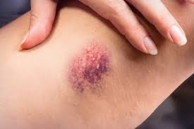 Check spelling or type a new query. Cuales Son Las Causas De La Tromboflebitis Superficial