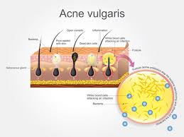 Seborrhoeic dermatitis is a type of skin inflammation in the areas abundant in sebaceous glands, e.g. Sebum Buildup 3 Causes 2 Steps To Get Rid Of It Hairguard