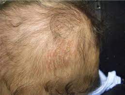 The lack of bile as mentioned above is however the major reason for the occurrence of this particular condition. White Specks In The Hair Visual Diagnosis And Treatment In Pediatrics 3 Ed