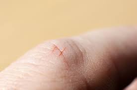 Why A Tiny Paper Cut Can Cause Such Agony | Cnn