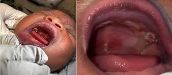 Image result for Neonatal Teeth