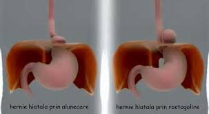 Hernia Hiatala Si Boala De Reflux Gastro Esofagian Page 14 Medlife