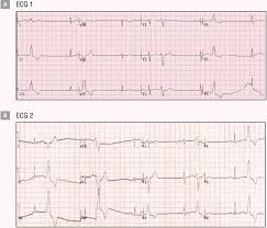 Premature ventricular contractions (pvcs) are extra heartbeats that begin in one of your heart's two lower pumping chambers (ventricles). Two Different Left Bundle Branch Block Patterns Of Premature Ventricular Contraction Originating From Right Coronary Cusp