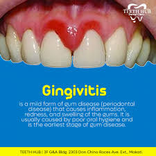 Image result for Gingivitis