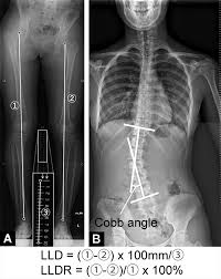 Image result for Functional Leg Length Discrepancy
