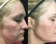 Image of PRP facial treatment before and after results Riyadh clinics