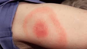 Image result for wolf spider bite skin