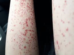 Eksem membuat ruam kulit yang gatal dan merah karena peradangan. Muncul Bintik Merah Alma Ternyata Alami Pembuluh Darah Pecah Health Liputan6 Com