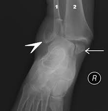Pain localized to the lateral subtalar region is often clinically felt to represent either subtalar joint degeneration or sinus tarsi syndrome. Ankle Fracture Wikipedia