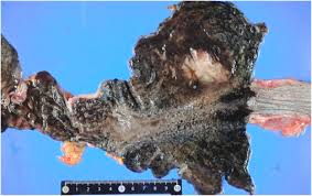 Autopsy 4 will run on linux and os x. An Autopsy Case Of Acute Poisoning Via Ingestion Of Hydrofluoric Acid Sciencedirect