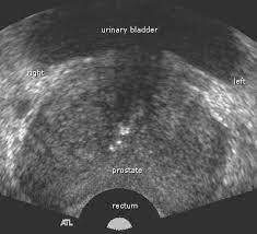Hearing the doctor tell you that you've got cancer is undoubtedly one of the worst things you may experience. Prostate Ultrasound