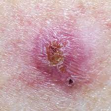 Basal cell adenocarcinoma and basaloid squamous cell carcinoma (with significant cytological atypia, mitosis and necrosis) (am j clin pathol 2002;118:s100) membranous basal cell adenoma simulates adenoid cystic carcinoma (j cytol 2018;35:55) Basal Cell Carcinoma Surgeries For Skin Lesions Toronto Minor Surgery Center Tmsc