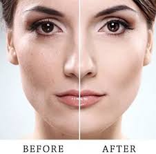 How To Get Rid Of Peach Fuzz On Face It Is Common For Women To Have A Thin Layer Of Peach Fuzz On Face Peach Fuzz Peach Fuzz Removal