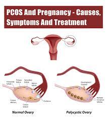 Pcos And Pregnancy Symptoms Treatment Tips To Conceive