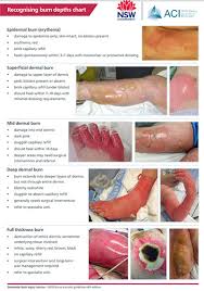 Image result for Burn Management