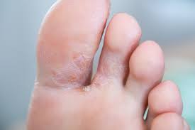 What Is Athlete S Foot Health Beat